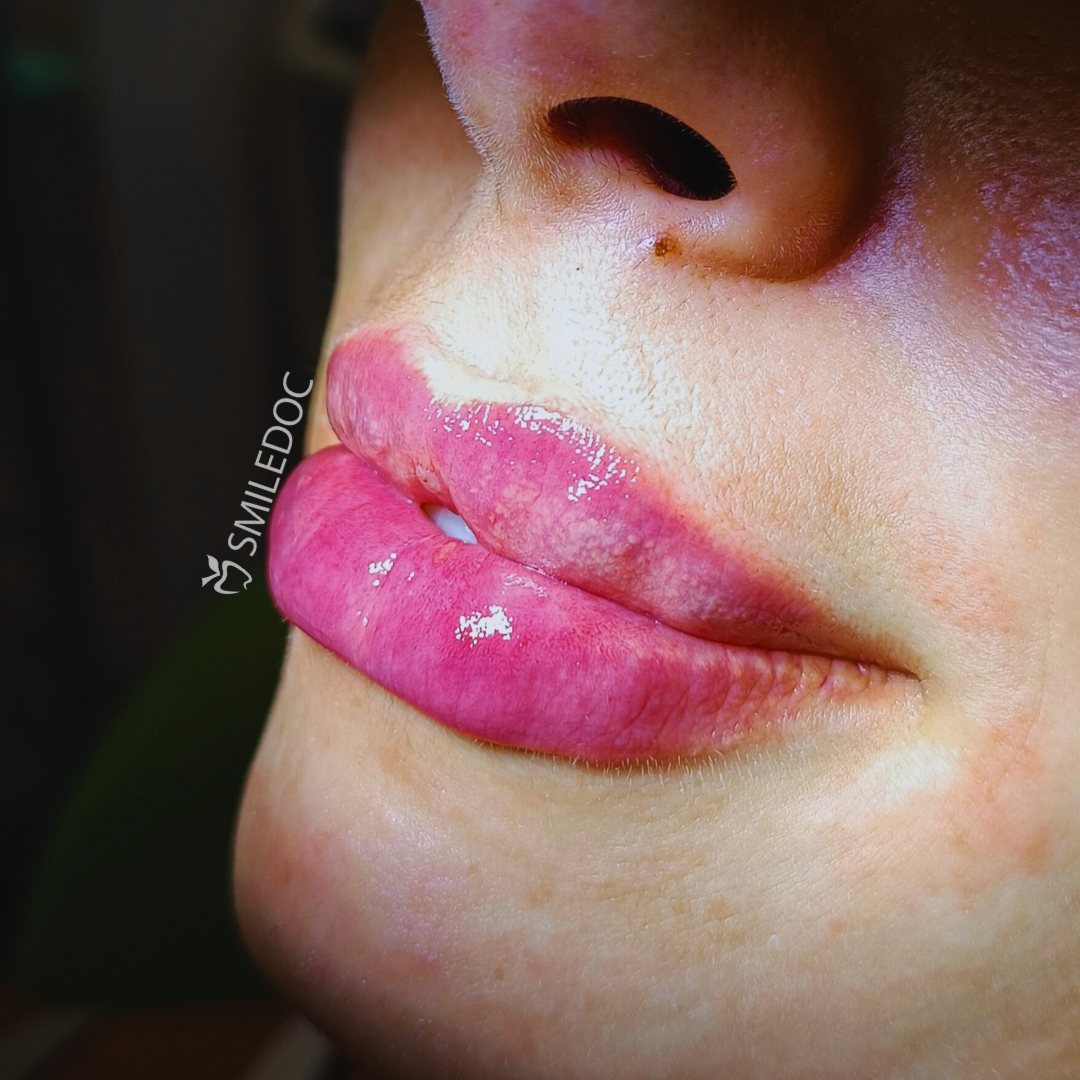 Filler labbra con acido ialuronico - Dott.ssa Di Vozzo