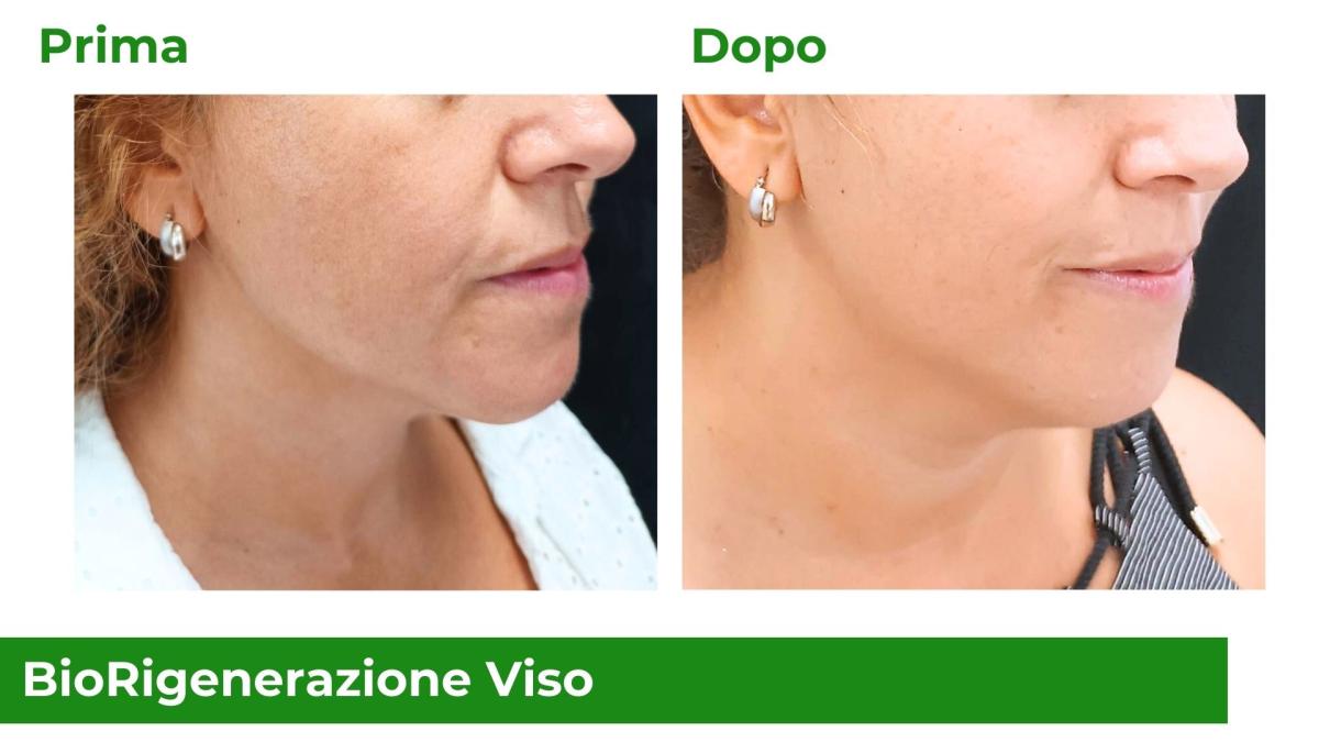 Filler labbra - prima e dopo